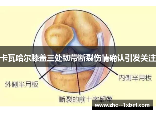 卡瓦哈尔膝盖三处韧带断裂伤情确认引发关注